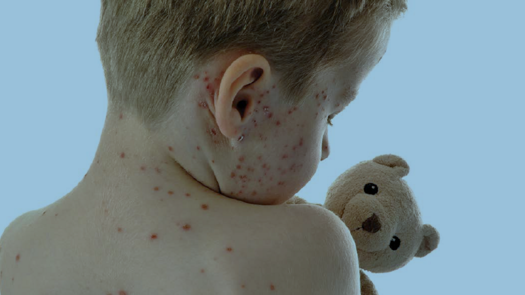 Cover photo for EPSDT newsletter shows young child with measles holding a teddy bear and facing away from camera